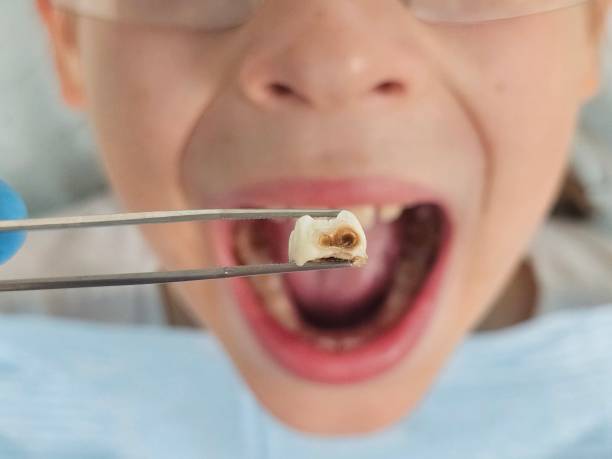 Best Emergency Tooth Extraction in Huntland, TN