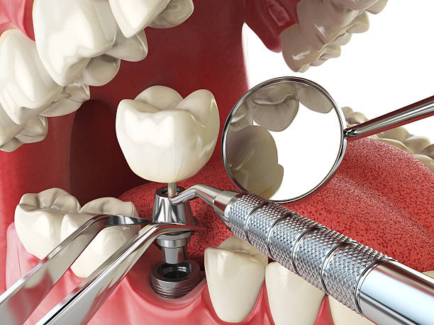 Best Emergency Dental Care for Broken or Chipped Teeth in Huntland, TN